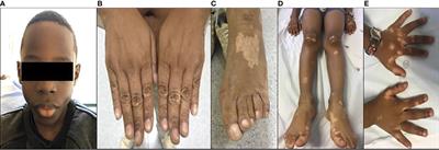 Case Report: Wide Spectrum of Manifestations of Ligase IV Deficiency: Report of 3 Cases